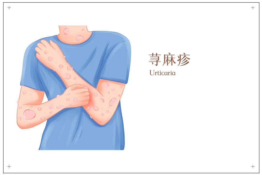 身上一热就起痒疙瘩，怎么办 | 科普时间